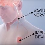 Perangkat ini Membantu Pasien Stroke Pulih Lebih Cepat